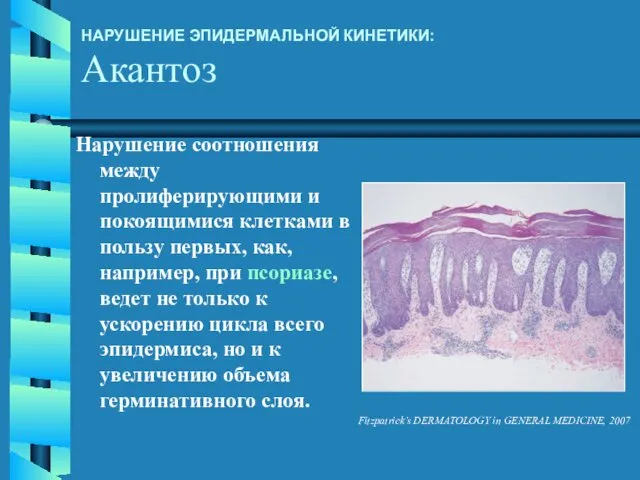 НАРУШЕНИЕ ЭПИДЕРМАЛЬНОЙ КИНЕТИКИ: Акантоз Нарушение соотношения между пролиферирующими и покоящимися