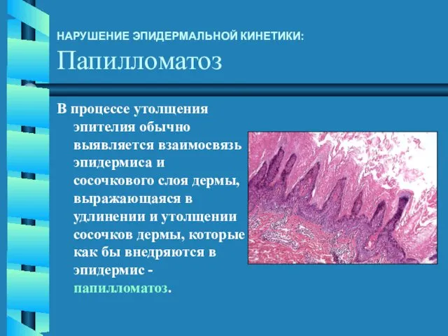 В процессе утолщения эпителия обычно выявляется взаимосвязь эпидермиса и сосочкового