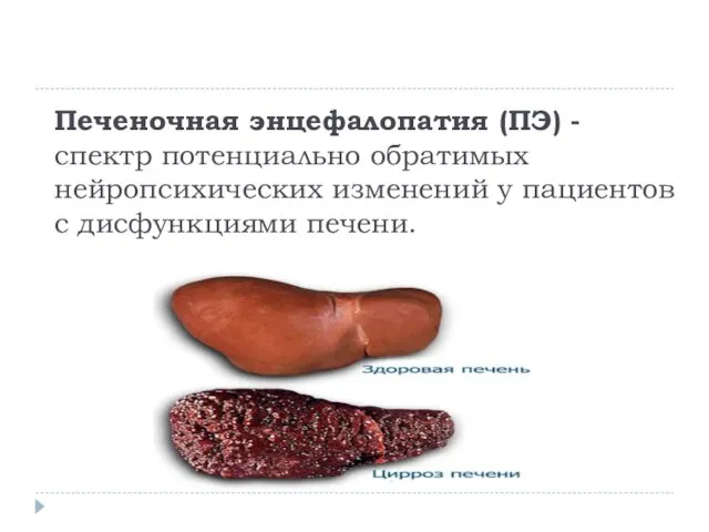 Печеночная энцефалопатия (ПЭ) -спектр потенциально обратимых нейропсихических изменений у пациентов с дисфункциями печени.