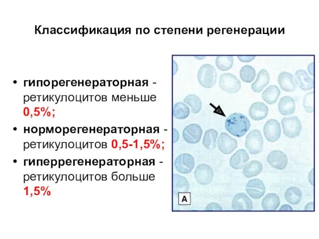 Классификация по степени регенерации гипорегенераторная - ретикулоцитов меньше 0,5%; норморегенераторная