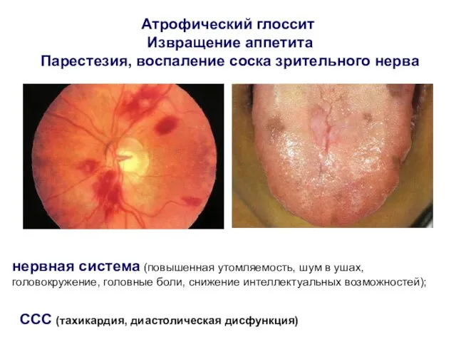 Атрофический глоссит Извращение аппетита Парестезия, воспаление соска зрительного нерва нервная