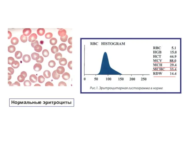 Нормальные эритроциты