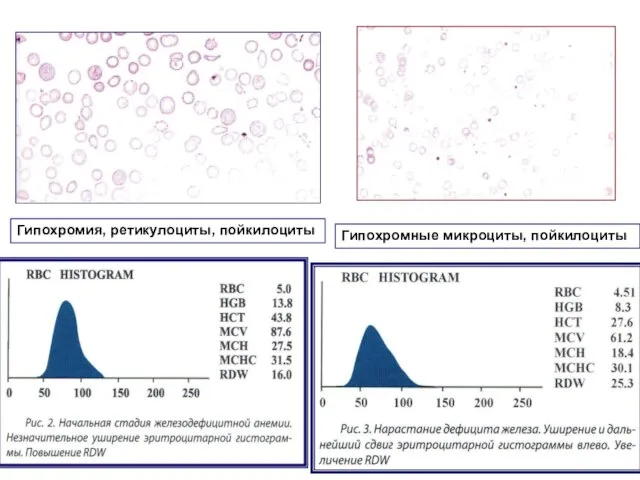 Гипохромные микроциты, пойкилоциты Гипохромия, ретикулоциты, пойкилоциты