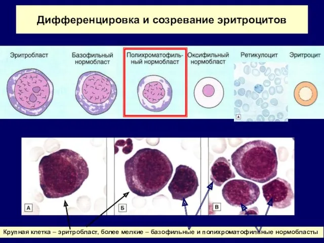 Дифференцировка и созревание эритроцитов Крупная клетка – эритробласт, более мелкие – базофильные и полихроматофильные нормобласты