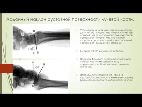 Ладонный наклон суставной поверхности лучевой кости. Угол между линией «а»,