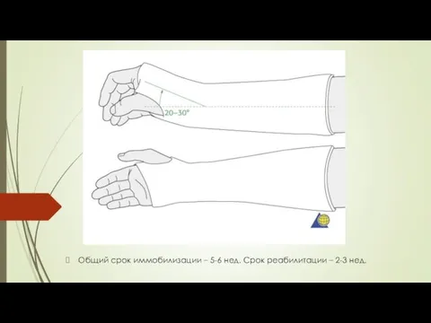 Общий срок иммобилизации – 5-6 нед. Срок реабилитации – 2-3 нед.