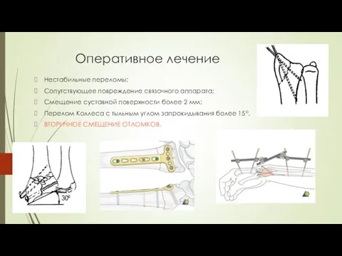 Оперативное лечение Нестабильные переломы; Сопутствующее повреждение связочного аппарата; Смещение суставной