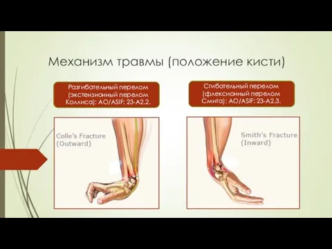 Механизм травмы (положение кисти) Разгибательный перелом (экстензионный перелом Коллиса): AO/ASIF: