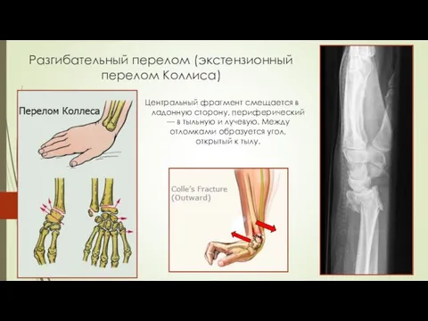 Разгибательный перелом (экстензионный перелом Коллиса) Центральный фрагмент смещается в ладонную