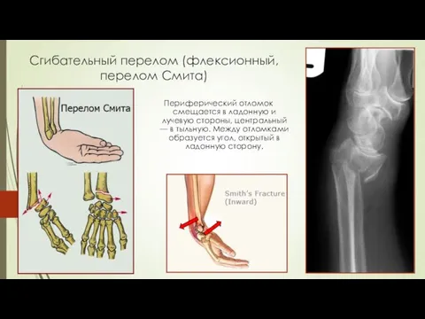 Сгибательный перелом (флексионный, перелом Смита) Периферический отломок смещается в ладонную