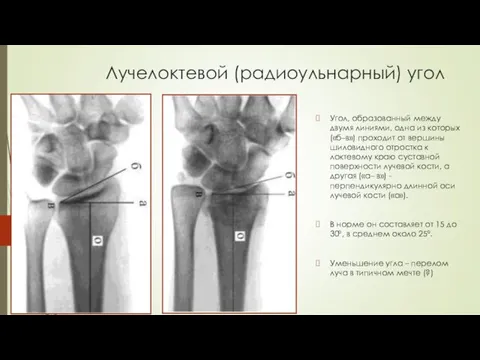 Лучелоктевой (радиоульнарный) угол Угол, образованный между двумя линиями, одна из