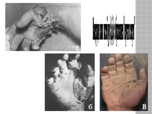 Мацерация кожи кистей рук (а,б,в) с образованием "перчаток смерти"