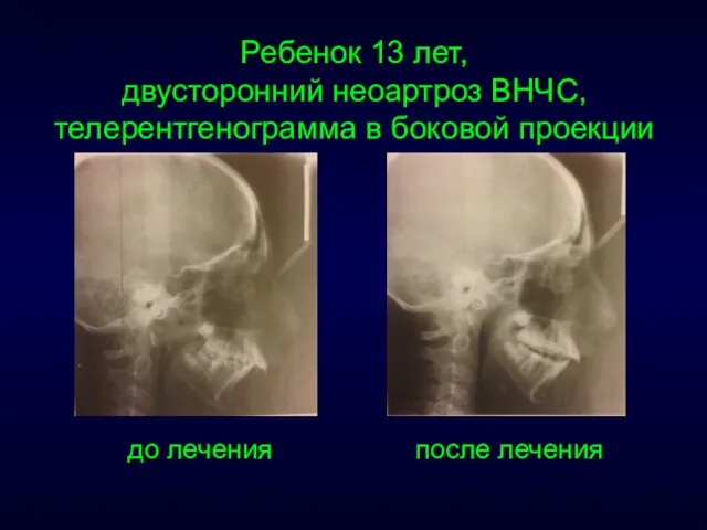 Ребенок 13 лет, двусторонний неоартроз ВНЧС, телерентгенограмма в боковой проекции до лечения после лечения