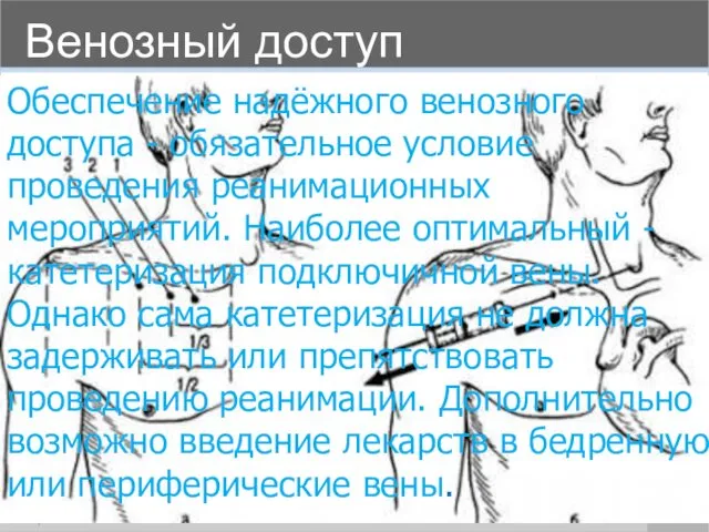 Венозный доступ 16 Обеспечение надёжного венозного доступа - обязательное условие