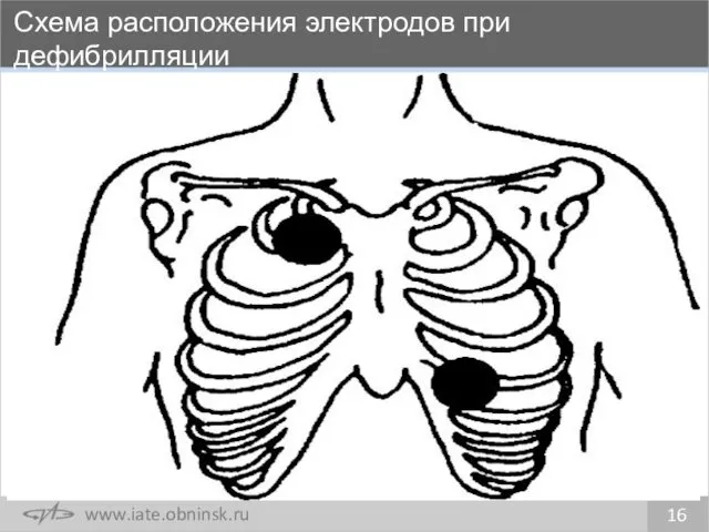 Схема расположения электродов при дефибрилляции 16