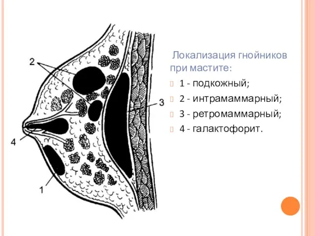 Локализация гнойников при мастите: 1 - подкожный; 2 - интрамаммарный; 3 - ретромаммарный; 4 - галактофорит.