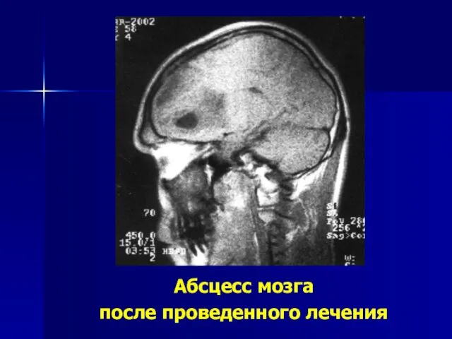 Абсцесс мозга после проведенного лечения