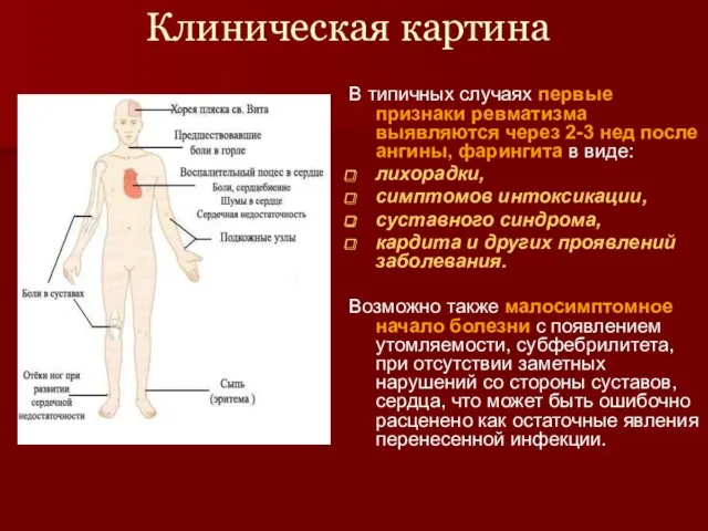 Клиническая картина В типичных случаях первые признаки ревматизма выявляются через 2-3 нед после