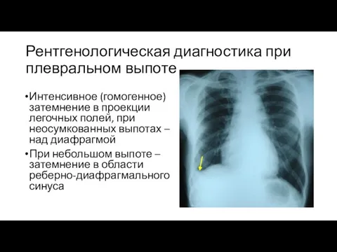 Рентгенологическая диагностика при плевральном выпоте Интенсивное (гомогенное) затемнение в проекции