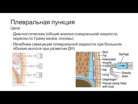 Плевральная пункция Цели Диагностическая (общий анализ плевральной жидкости, окраска по