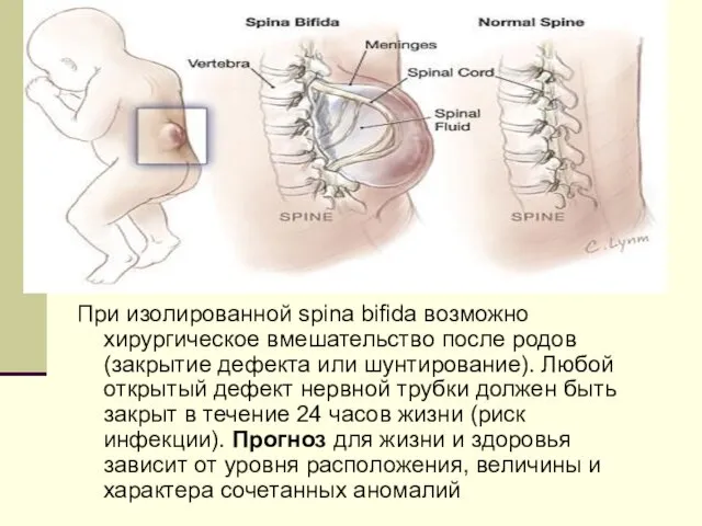 При изолированной spina bifida возможно хирургическое вмешательство после родов (закрытие дефекта или шунтирование).