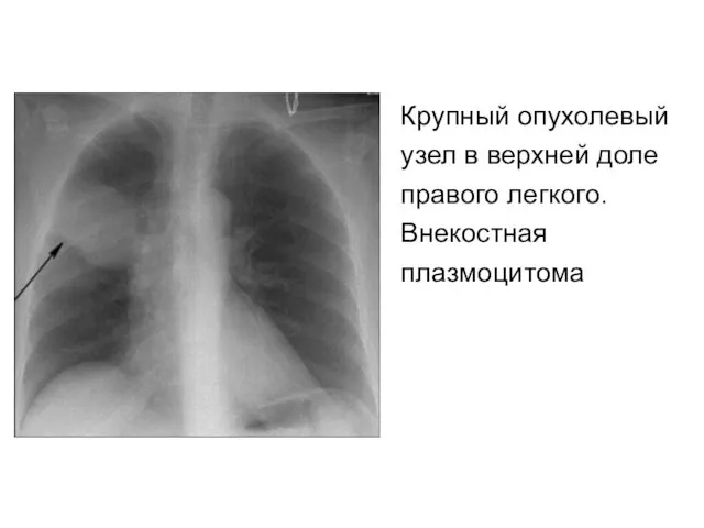 Крупный опухолевый узел в верхней доле правого легкого. Внекостная плазмоцитома