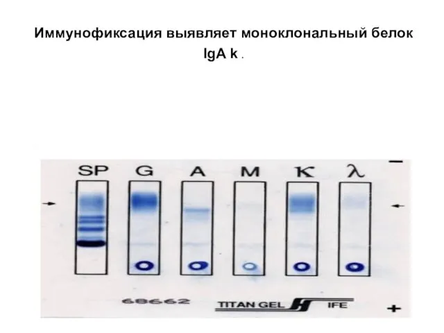 Иммунофиксация выявляет моноклональный белок IgA k .