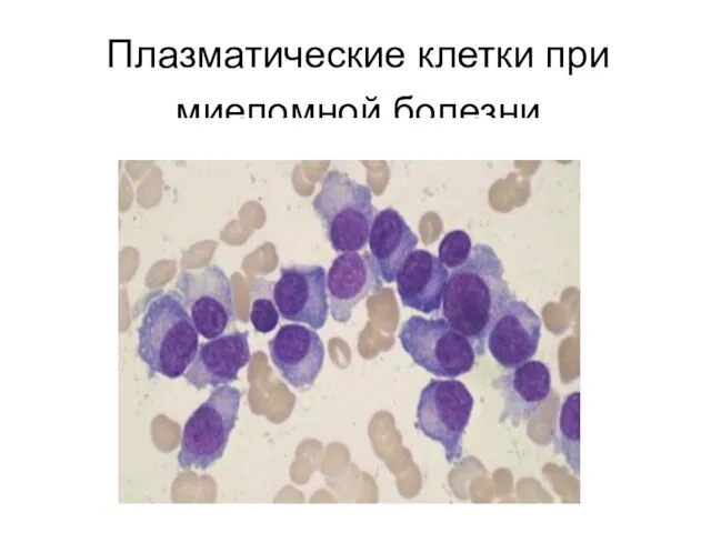 Плазматические клетки при миеломной болезни