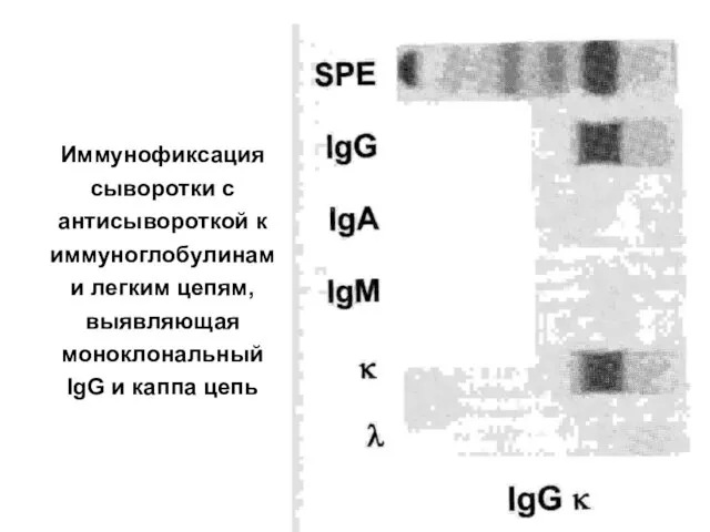 Иммунофиксация сыворотки с антисывороткой к иммуноглобулинам и легким цепям, выявляющая моноклональный IgG и каппа цепь