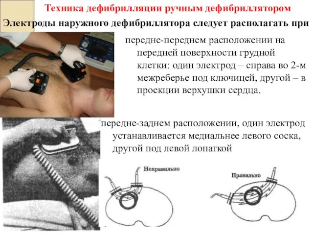 передне-заднем расположении, один электрод устанавливается медиальнее левого соска, другой под левой лопаткой Техника