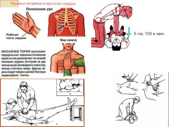 5 см, 100 в мин. Техника непрямого массажа сердца: