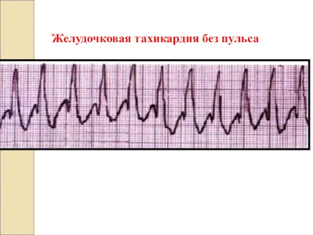 Желудочковая тахикардия без пульса