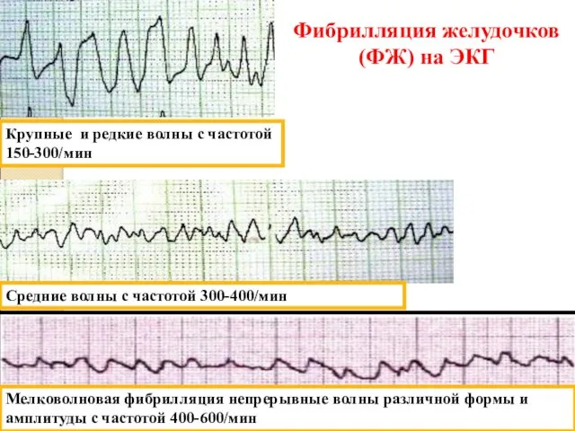 Мелковолновая фибрилляция непрерывные волны различной формы и амплитуды с частотой 400-600/мин Крупные и