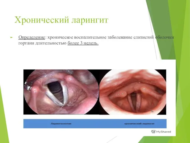 Хронический ларингит Определение: хроническое воспалительное заболевание слизистой оболочки гортани длительностью более 3 недель.