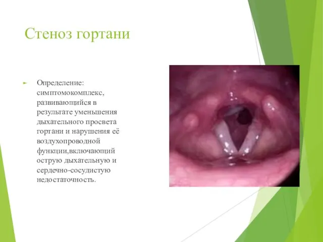 Стеноз гортани Определение: симптомокомплекс, развивающийся в результате уменьшения дыхательного просвета