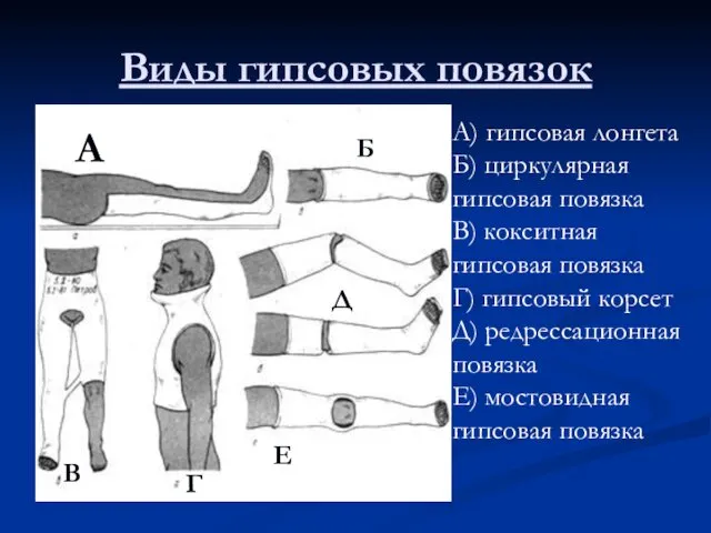 Виды гипсовых повязок А) гипсовая лонгета Б) циркулярная гипсовая повязка