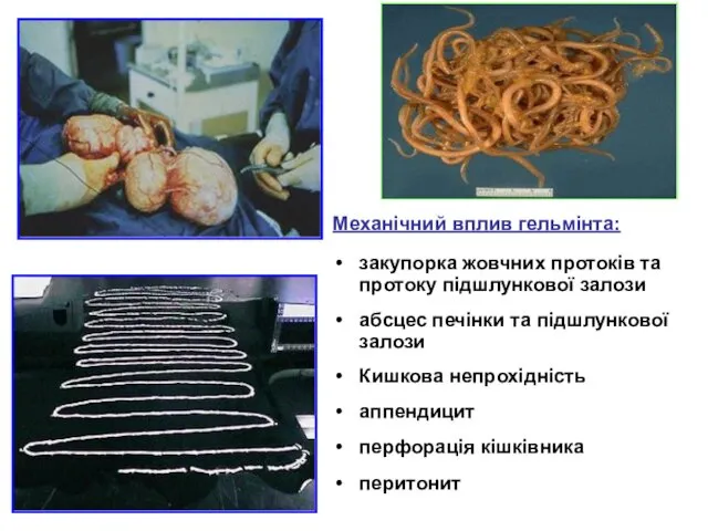 Механічний вплив гельмінта: закупорка жовчних протоків та протоку підшлункової залози