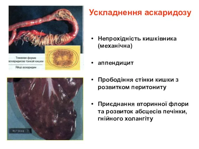 Ускладнення аскаридозу Непрохідність кишківника (механічна) аппендицит Прободіння стінки кишки з