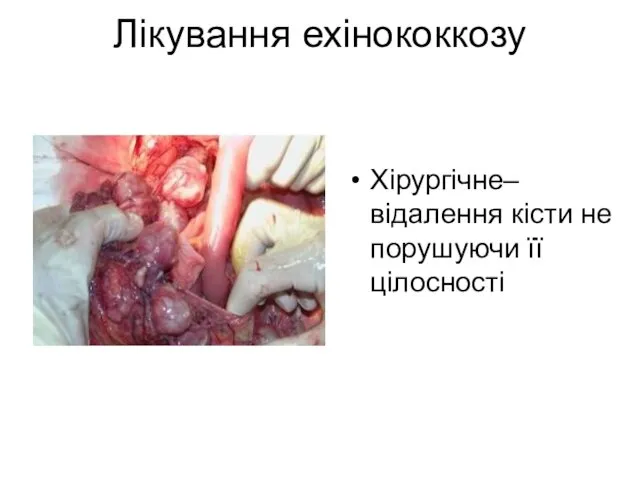 Лікування ехінококкозу Хірургічне– відалення кісти не порушуючи її цілосності