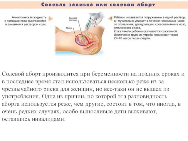 Солевой аборт производится при беременности на поздних сроках и в