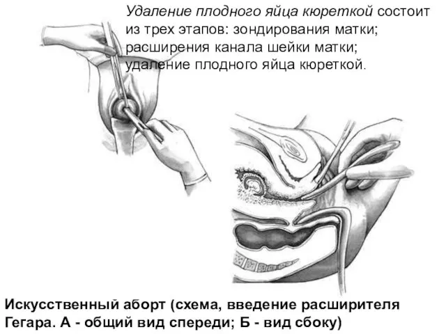 Искусственный аборт (схема, введение расширителя Гегара. А - общий вид