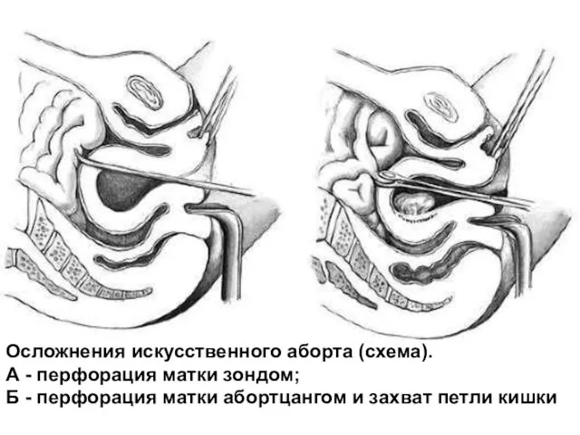 Осложнения искусственного аборта (схема). А - перфорация матки зондом; Б