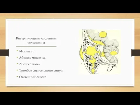 Внутричерепные отогенные осложнения Менингит Абсцесс мозжечка Абсцесс мозга Тромбоз сигмовидного синуса Отогенный сепсис