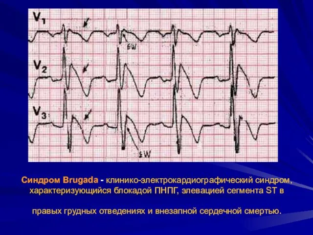 Синдром Brugada - клинико-электрокардиографический синдром, характеризующийся блокадой ПНПГ, элевацией сегмента ST в правых