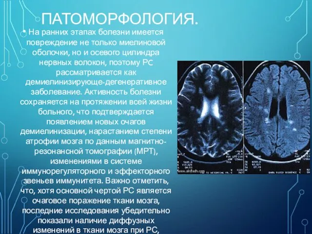 ПАТОМОРФОЛОГИЯ. На ранних этапах болезни имеется повреждение не только миелиновой