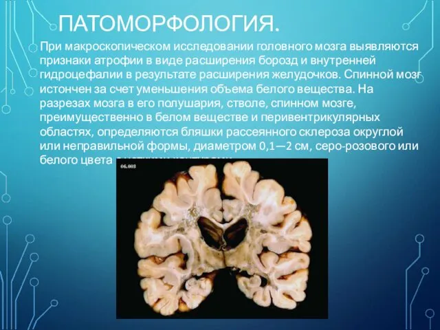 ПАТОМОРФОЛОГИЯ. При макроскопическом исследовании головного мозга выявляются признаки атрофии в