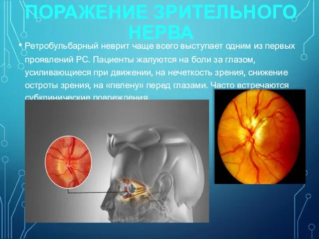 ПОРАЖЕНИЕ ЗРИТЕЛЬНОГО НЕРВА Ретробульбарный неврит чаще всего выступает одним из