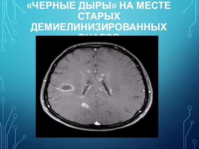 «ЧЕРНЫЕ ДЫРЫ» НА МЕСТЕ СТАРЫХ ДЕМИЕЛИНИЗИРОВАННЫХ ОЧАГОВ