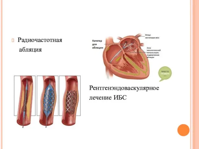 Радиочастотная абляция Рентгенэндоваскулярное лечение ИБС