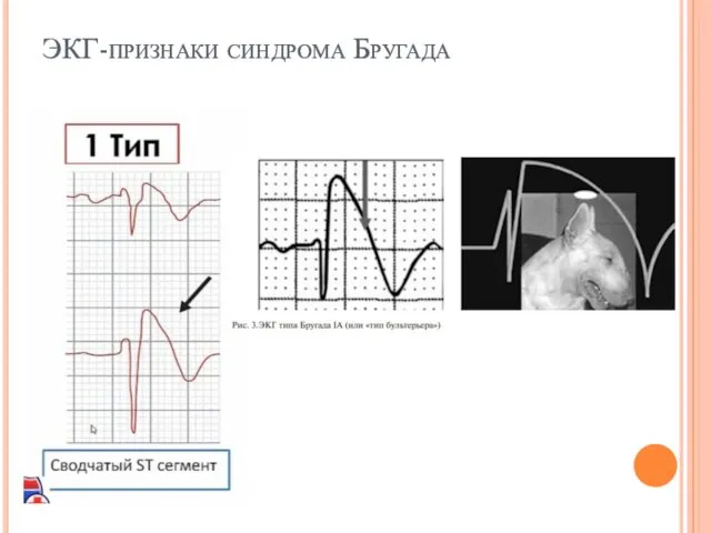 ЭКГ-признаки синдрома Бругада